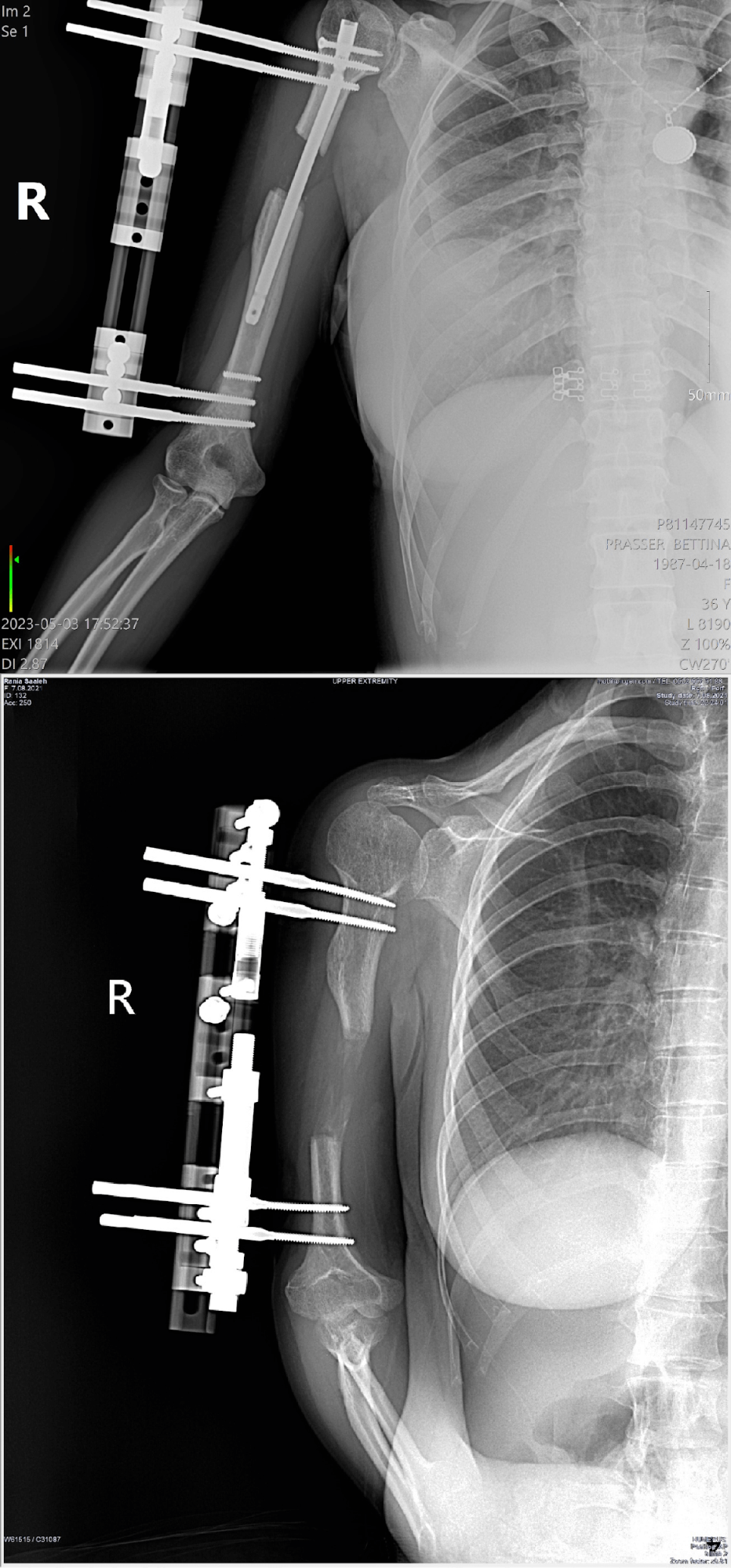 surgical humerus of arm